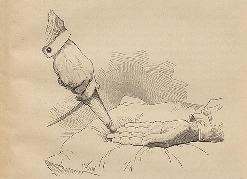 Ілюстрація з книжки «Leczenie ruchowe i mięsienie» («Моторотерапія і масаж») – посібник із мистецтва тогочасного масажу з використанням механічних вібраторів.